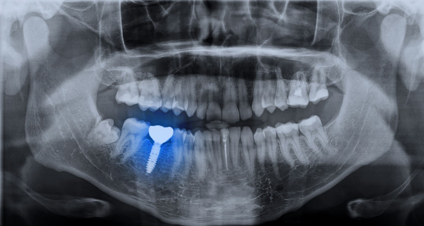 Radiographies panoramiques machoire 3D